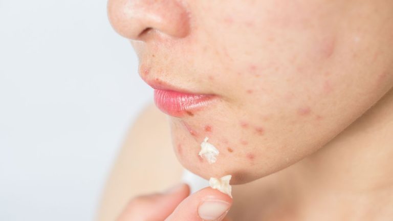 O que causa acne? Saiba como prevenir e conheça os principais tratamentos | Meio e Saúde Brasil