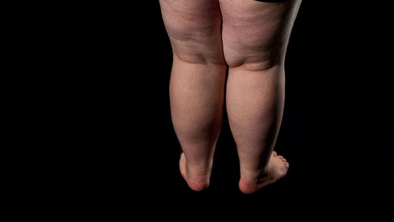 O que causa lipedema? Conheça sintomas e tratamentos para a doença | Meio e Saúde Brasil CNN Brasil