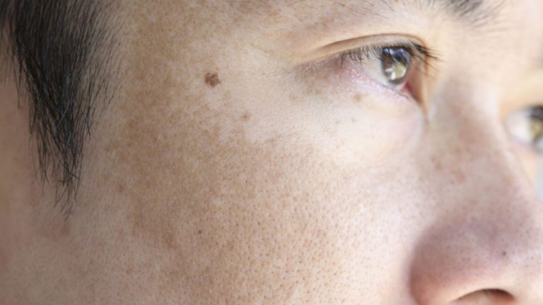 Melasma: conheça os principais sintomas e saiba como prevenir e tratar | Meio e Saúde Brasil