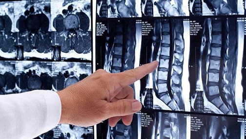 Saiba mais sobre a cirurgia minimamente invasiva da coluna