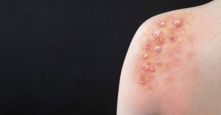 Mpox: Reino Unido detecta caso da nova variante pela primeira vez