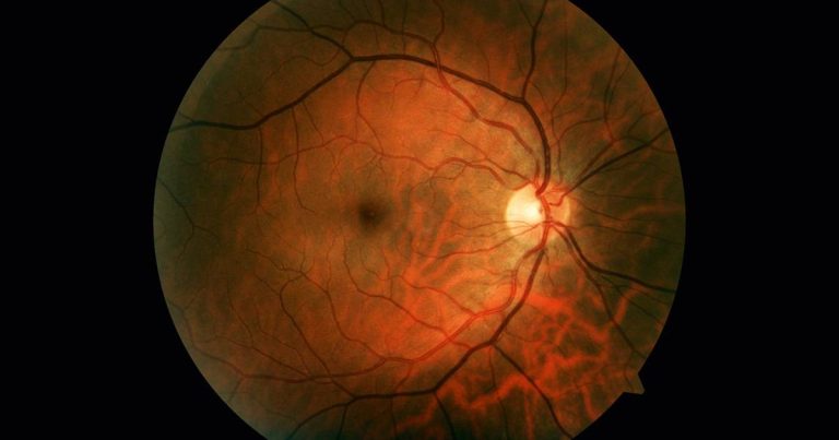 Retinopatia diabética e as cifras invisíveis que rondam a perda de visão | Letra de Médico